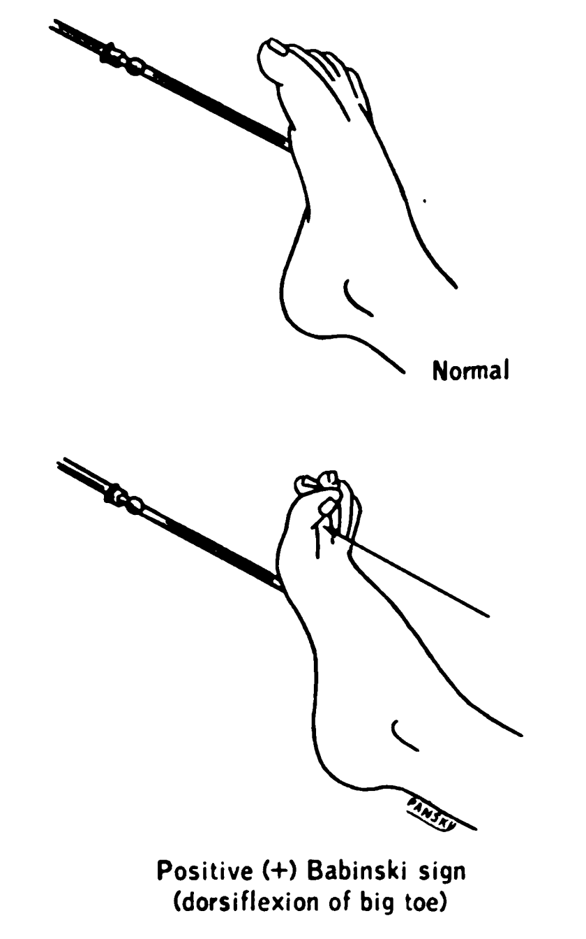 Babinski Reflex | Treatment & Management | Point of Care