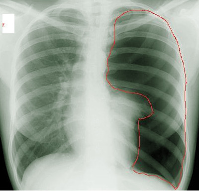 Iatrogenic Pneumothorax Article