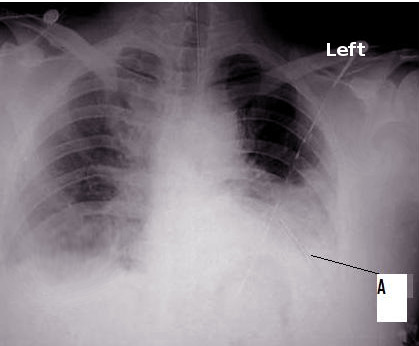 Hemothorax | Treatment & Management | Point of Care