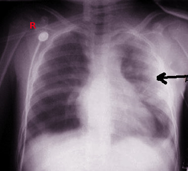 Pulmonary Contusion Article