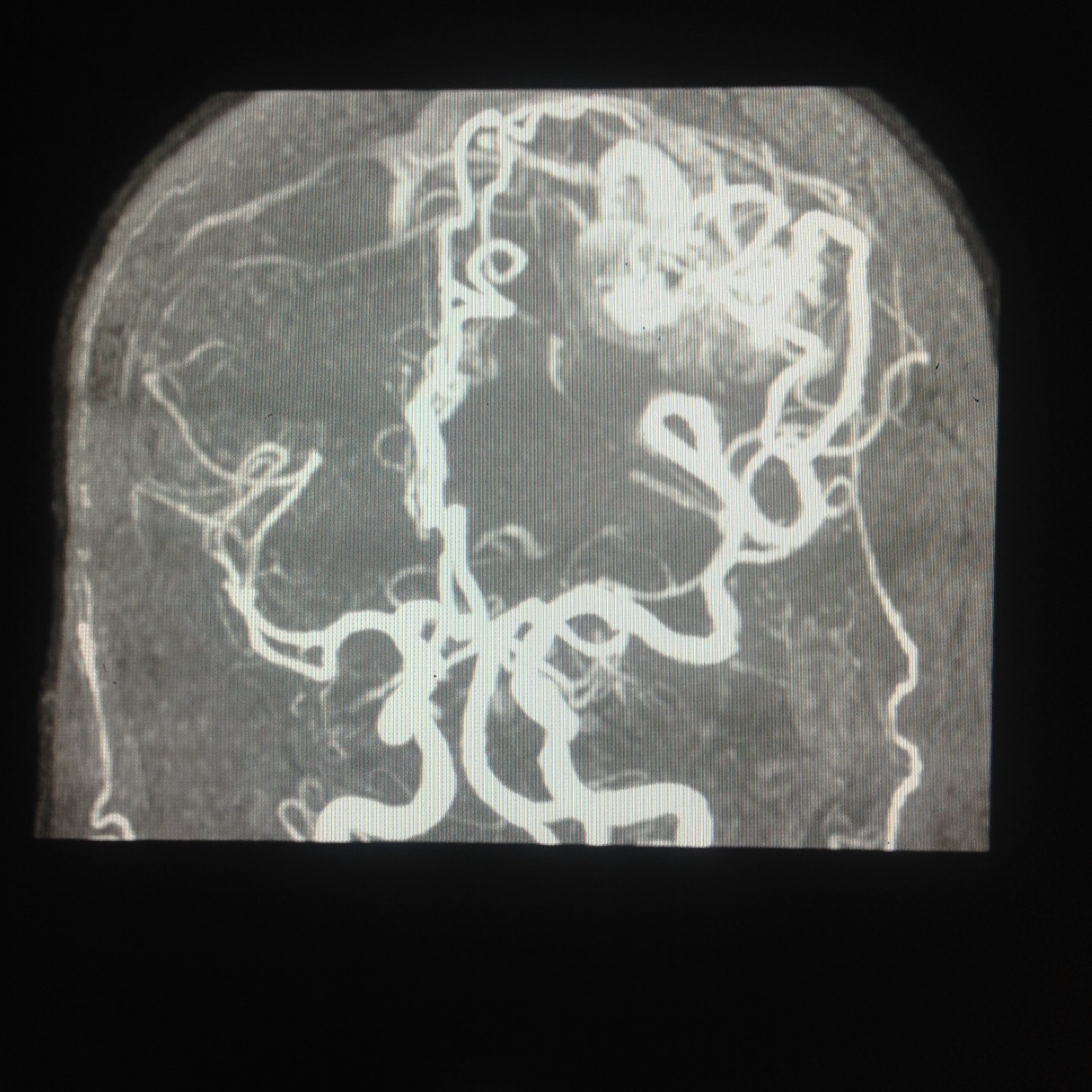 Arteriovenous Malformation Of The Brain Article