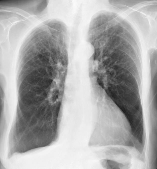 Critically Based Teaching Assignment Chronic Obstructive Pulmonary