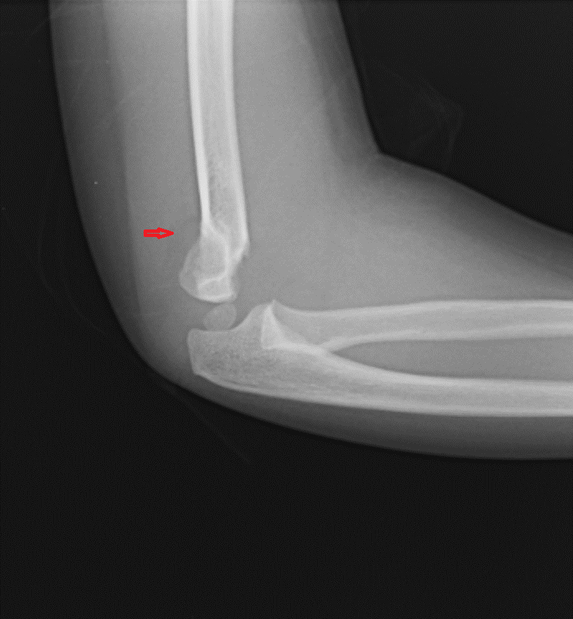 Supracondylar Fracture Fat Pad Sign