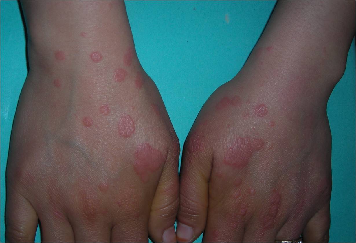 Erythema Multiforme Article