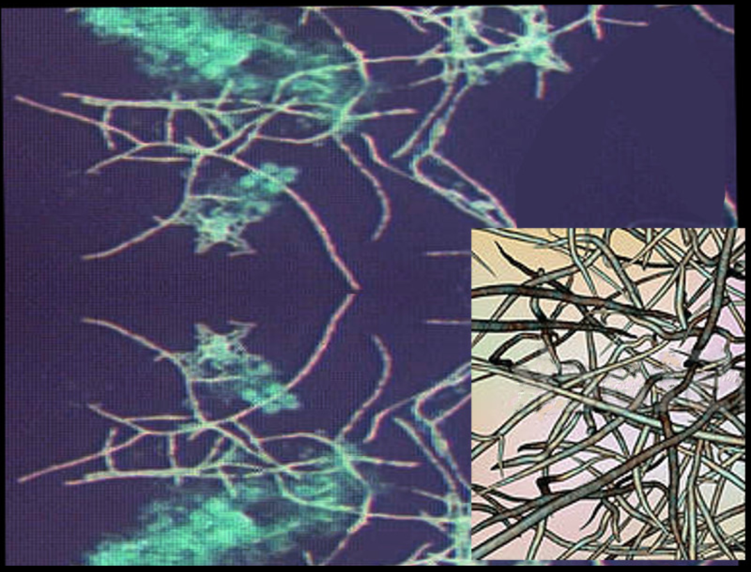 Nocardia | Treatment & Management | Point of Care