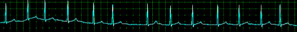 Atrial Fibrillation Nursing Article 0404