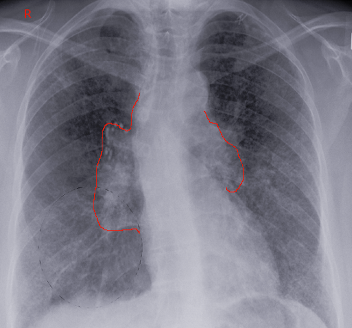 lymphadenopathy-article