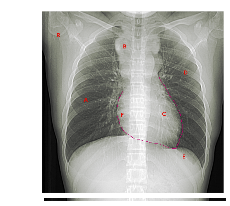 Anterior Mediastinal Mass | Treatment & Management | Point of Care