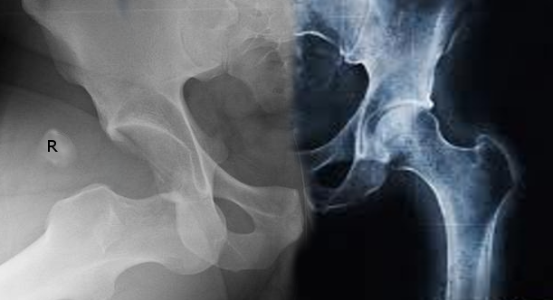 Anterior Hip Dislocation | Treatment & Management | Point of Care