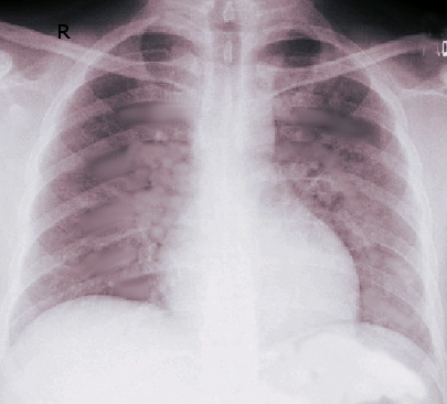 Acute Respiratory Distress Syndrome Article