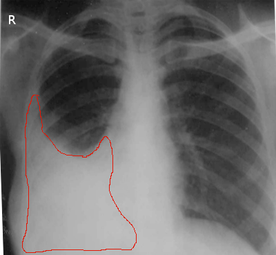 Pleural Effusion Article