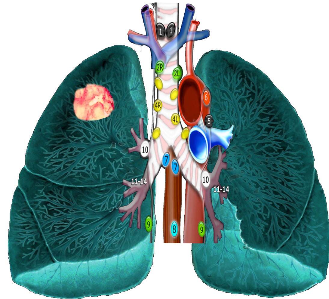 Anatomy, Thorax, Mediastinal Lymph Nodes | Treatment & Management ...