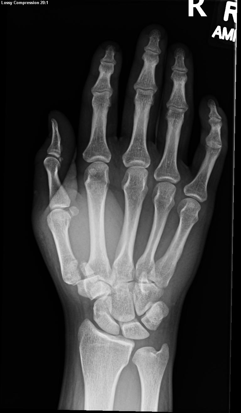 Bennett Fracture | Treatment & Management | Point of Care