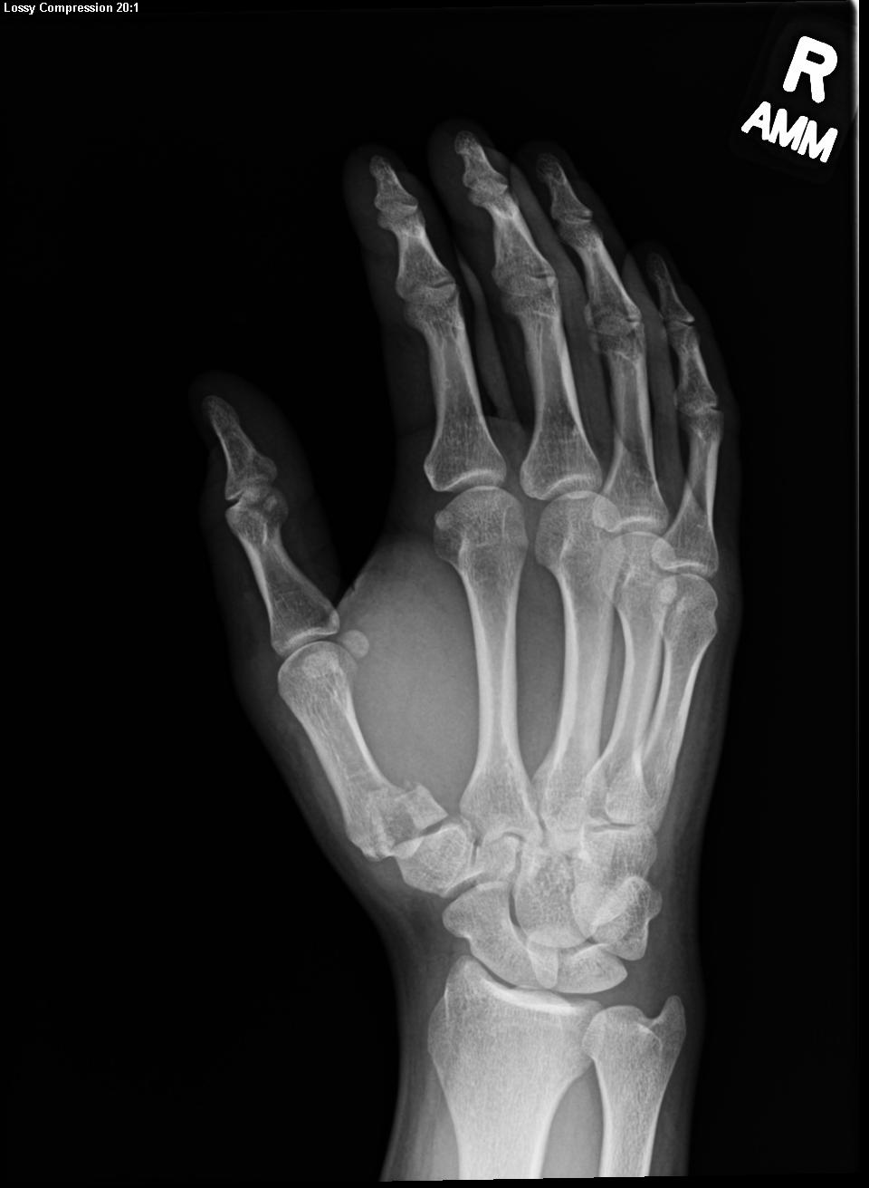 Bennett Fracture | Treatment & Management | Point of Care