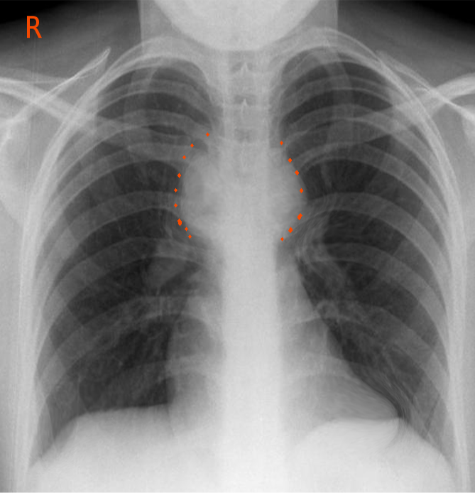 Adenopathy Article