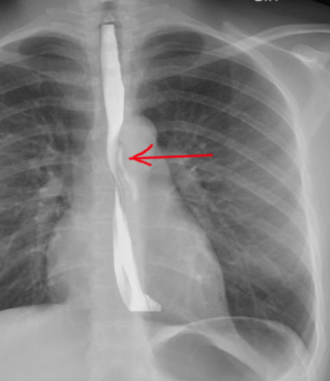 Esophageal Trauma Article