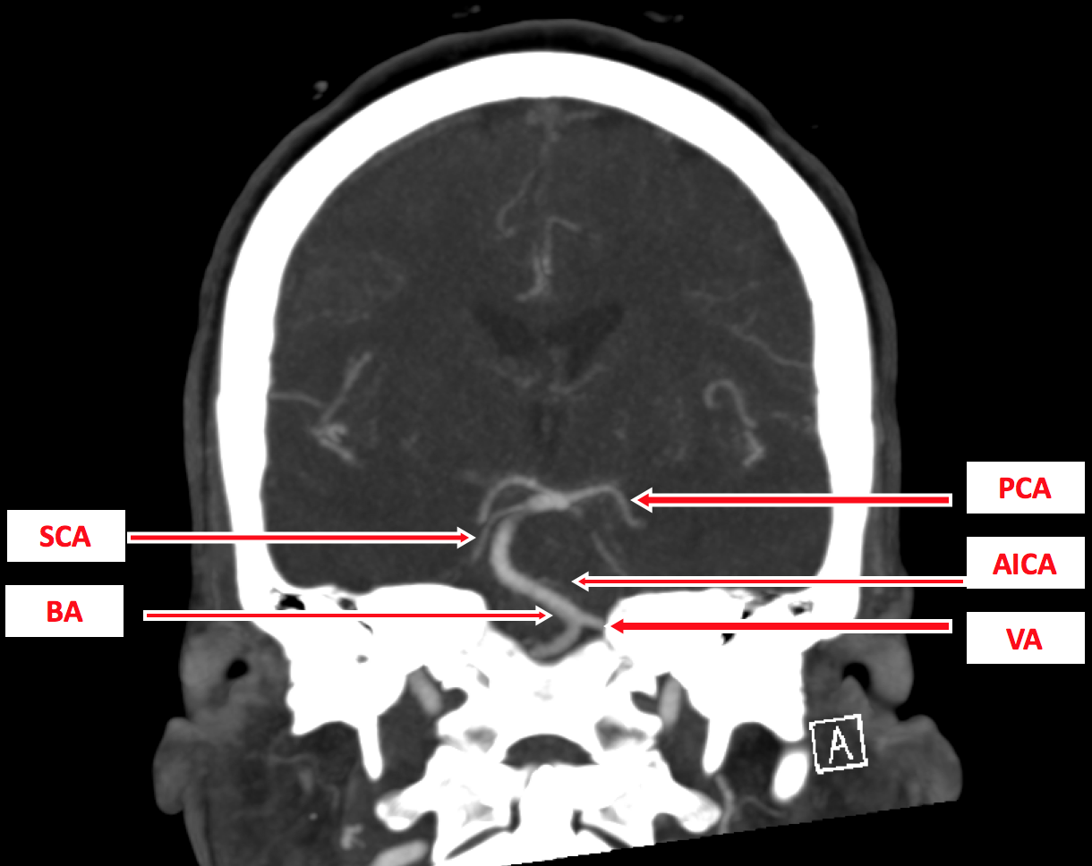 Basilar Artery Infarct 