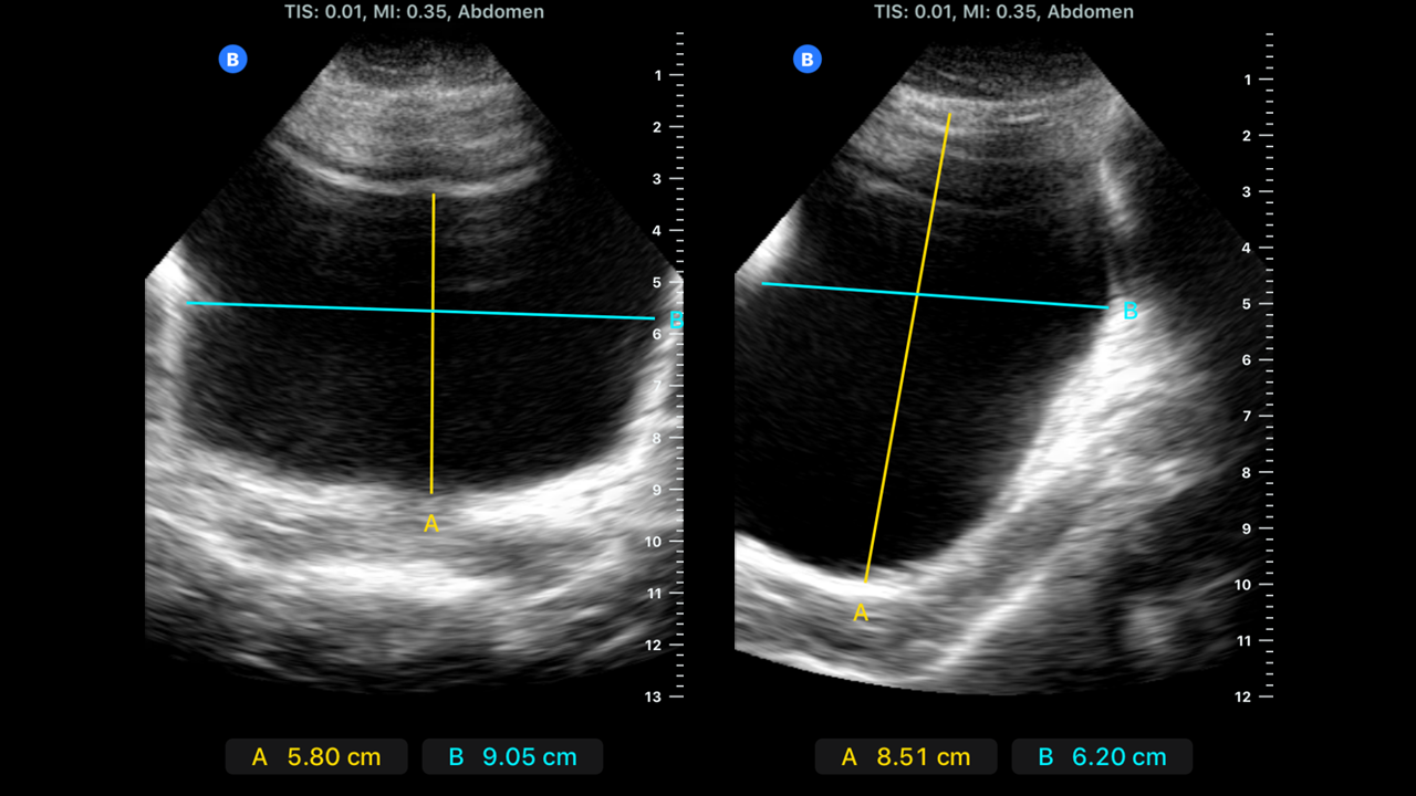 Bladder Post Void Residual Volume | Treatment & Management | Point of Care