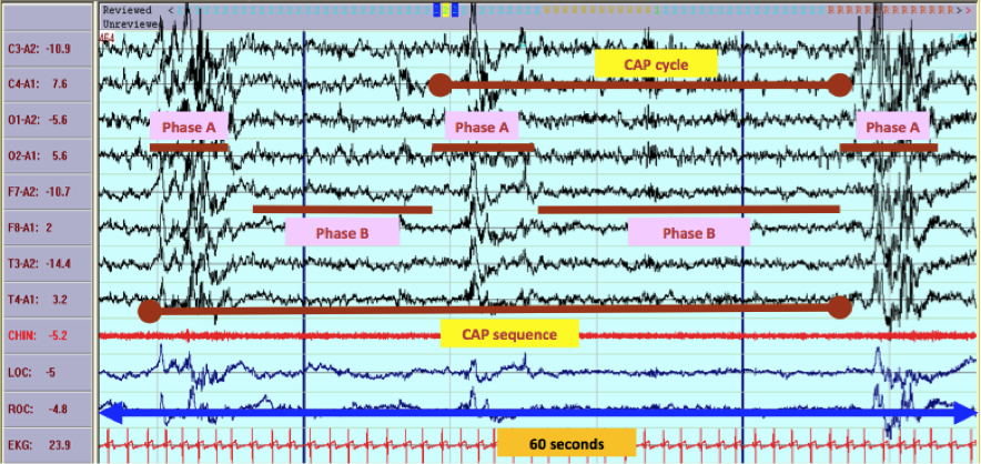 EEG Normal Sleep Article