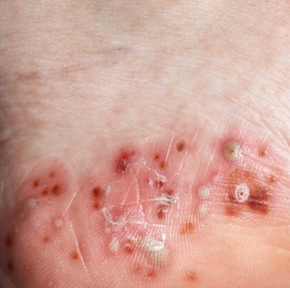 Pustular Psoriasis | Treatment & Management | Point of Care