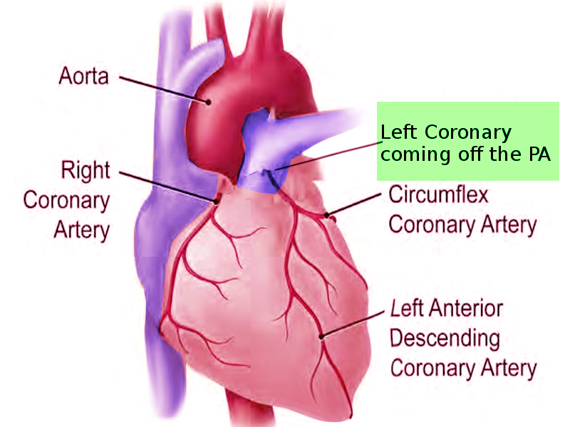 anatomy-thorax-heart-anomalous-left-coronary-artery-treatment