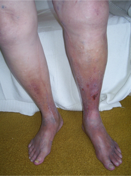 Chronic Venous Insufficiency - The Foot Force Podiatry