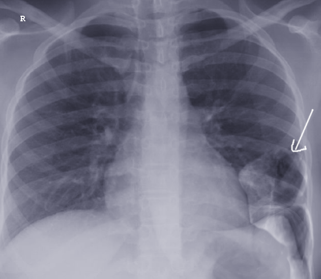 Diaphragmatic Hernia | Treatment & Management | Point of Care