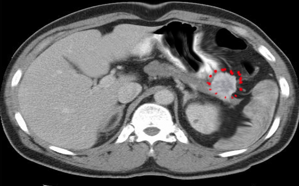 Zollinger Ellison Syndrome Treatment