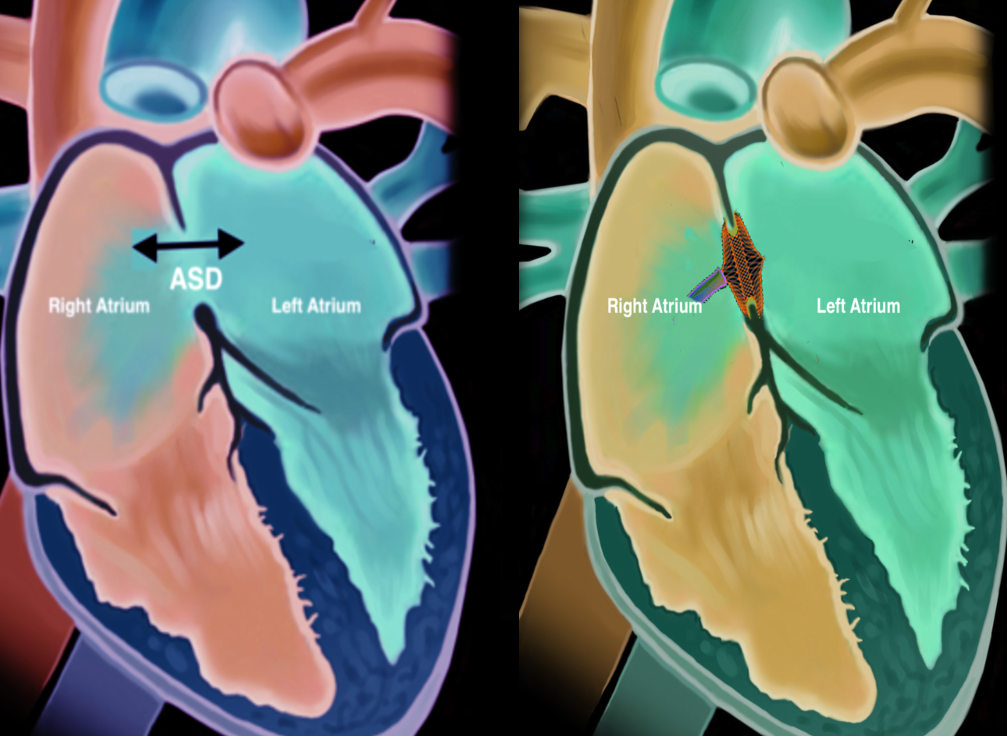 Catheter Management Of Atrial Septal Defect Article - StatPearls