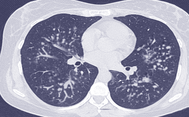 Silicosis | Treatment & Management | Point of Care