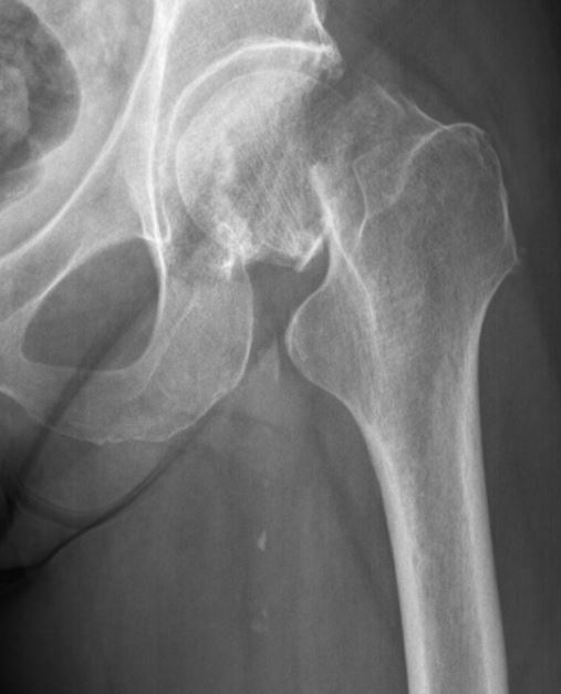 Surgical Management Of Femoral Neck Fractures Treatment And Management