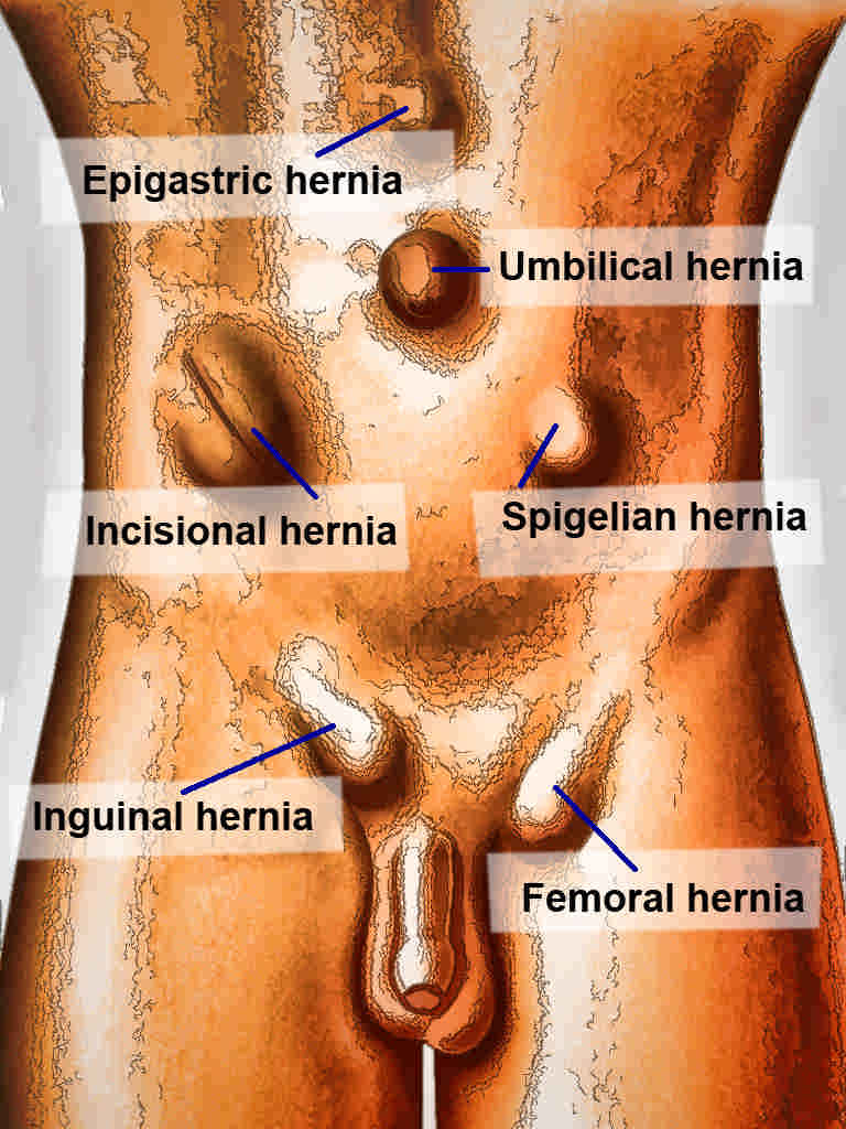 femoral hernia male