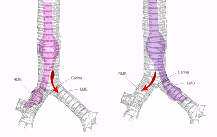 Single-Lung Ventilation | Treatment & Management | Point of Care