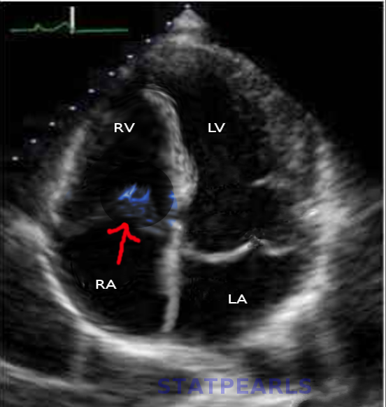 Tricuspid Valve Endocarditis Article