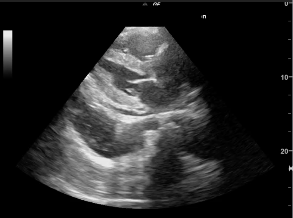 Hemothorax | Treatment & Management | Point of Care