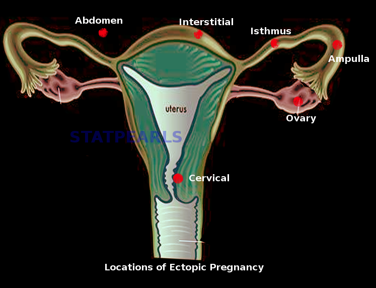 Ectopic Pregnancy Article