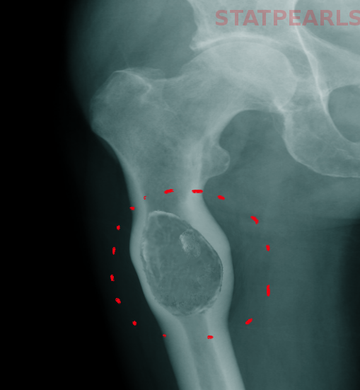 Aneurysmal Bone Cysts Treatment And Management Point Of Care 2401