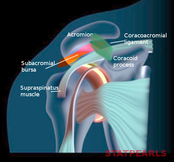 Subacromial Bursitis Article