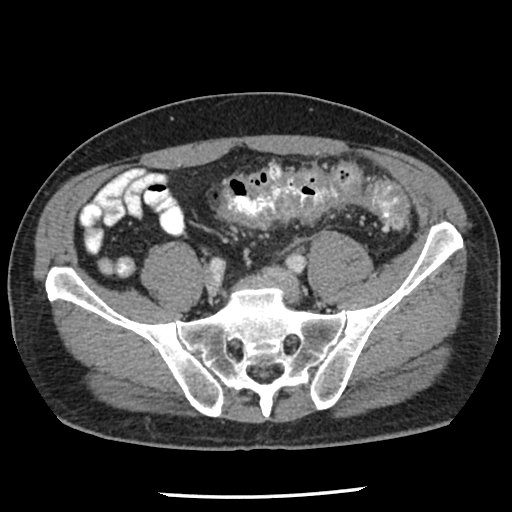 Acute Diverticulitis Article