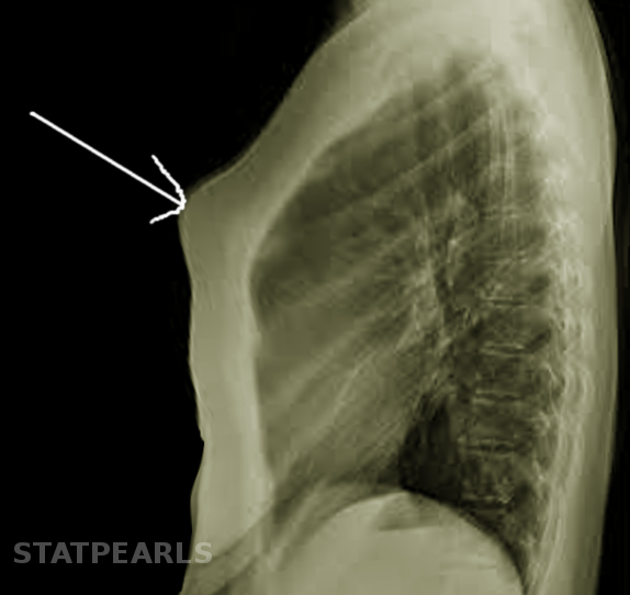 Pectus Carinatum (Pigeon Chest) Article StatPearls